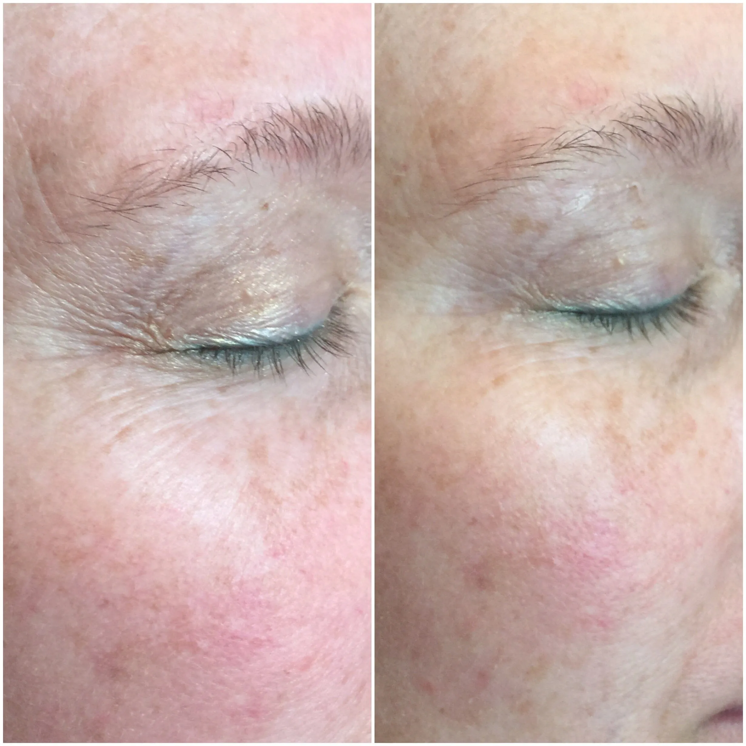 CO2Lift® Pro Carboxy Gel Treatment